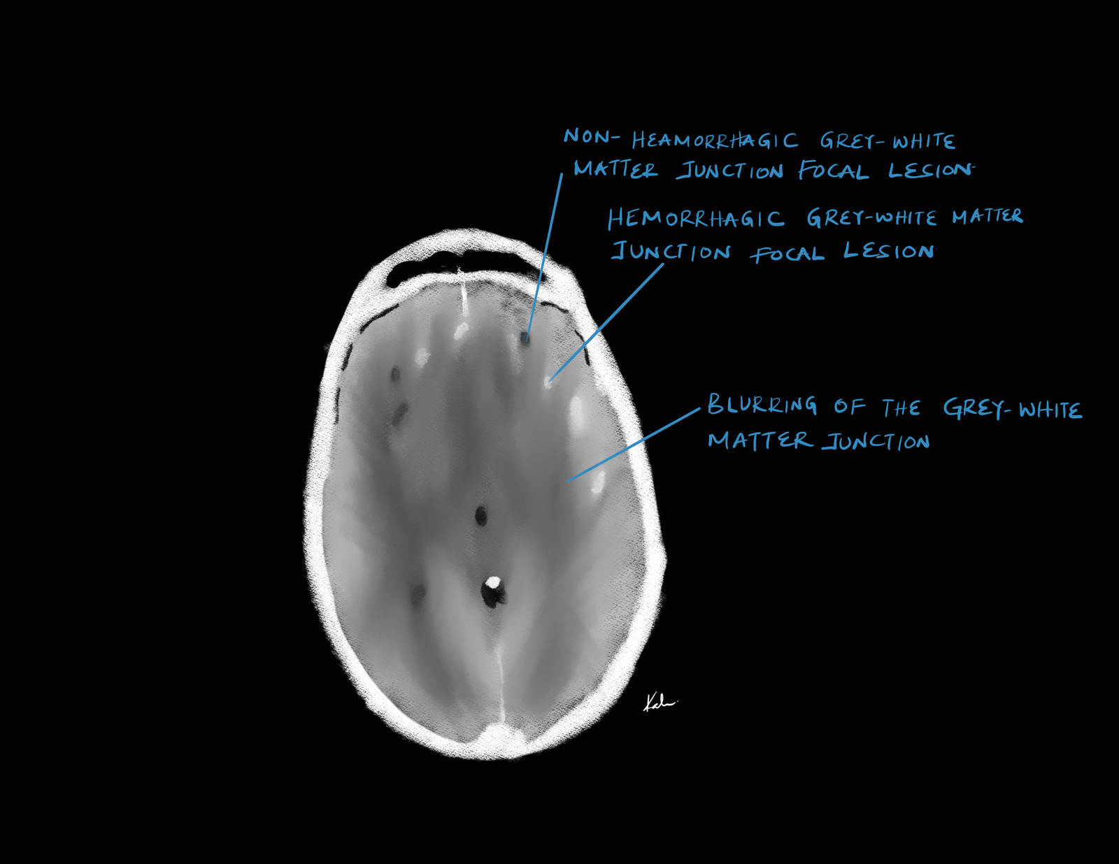 Diffuse axonal injury