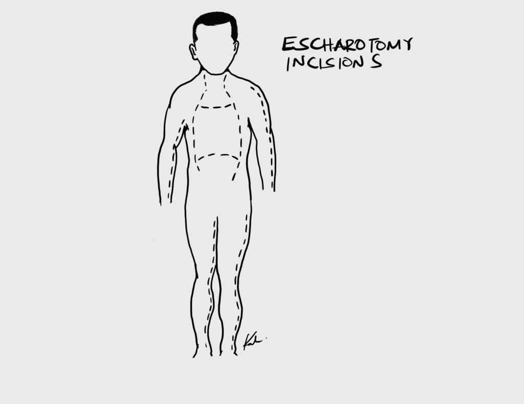 Escharotomy incisions