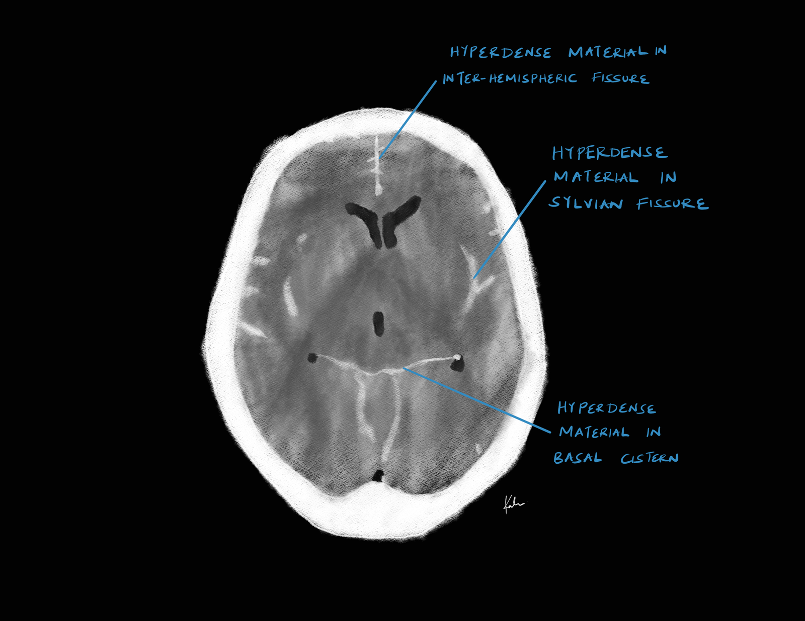 Subarachnoid hemorrhage