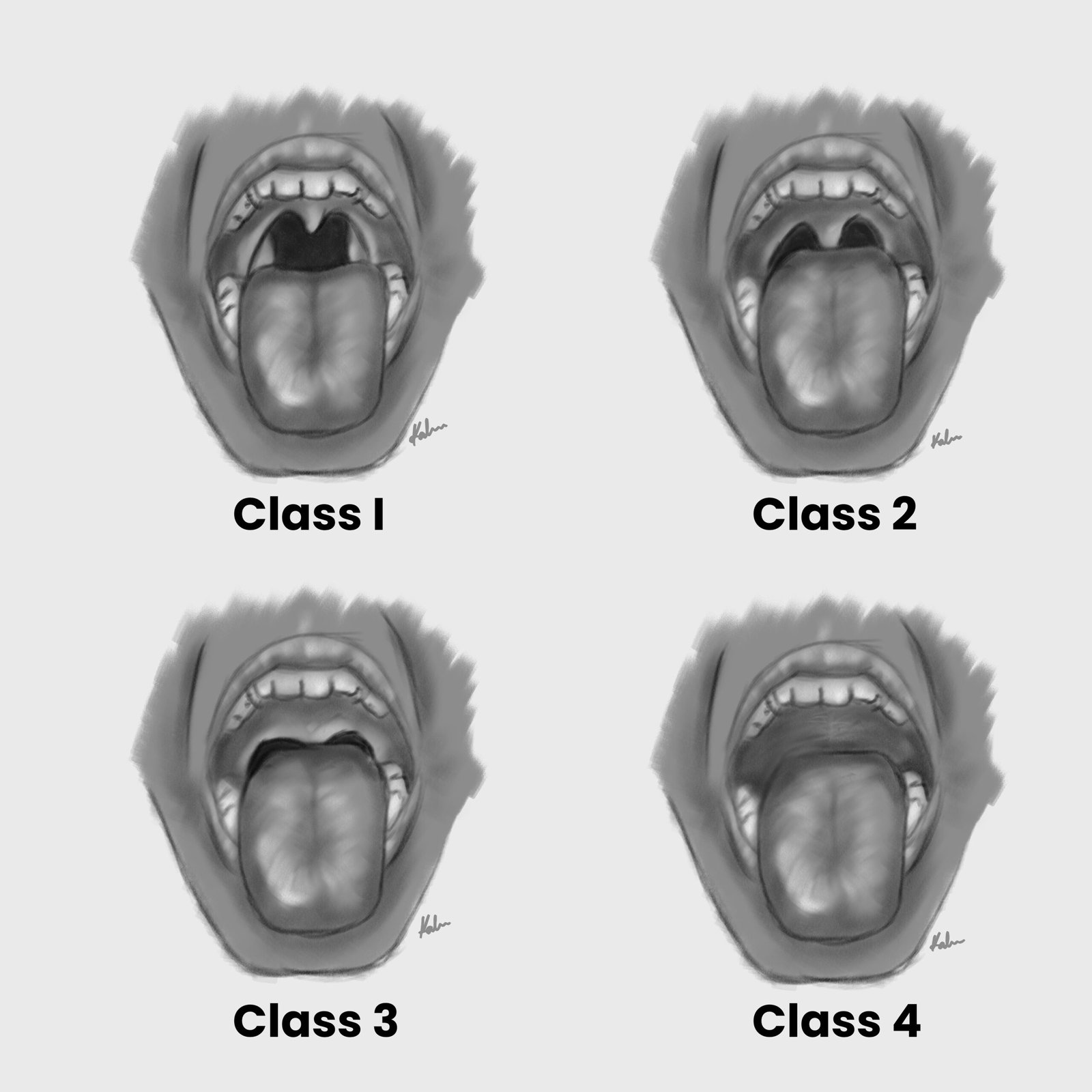 Mallampati score to assess the difficulty of orotracheal intubation