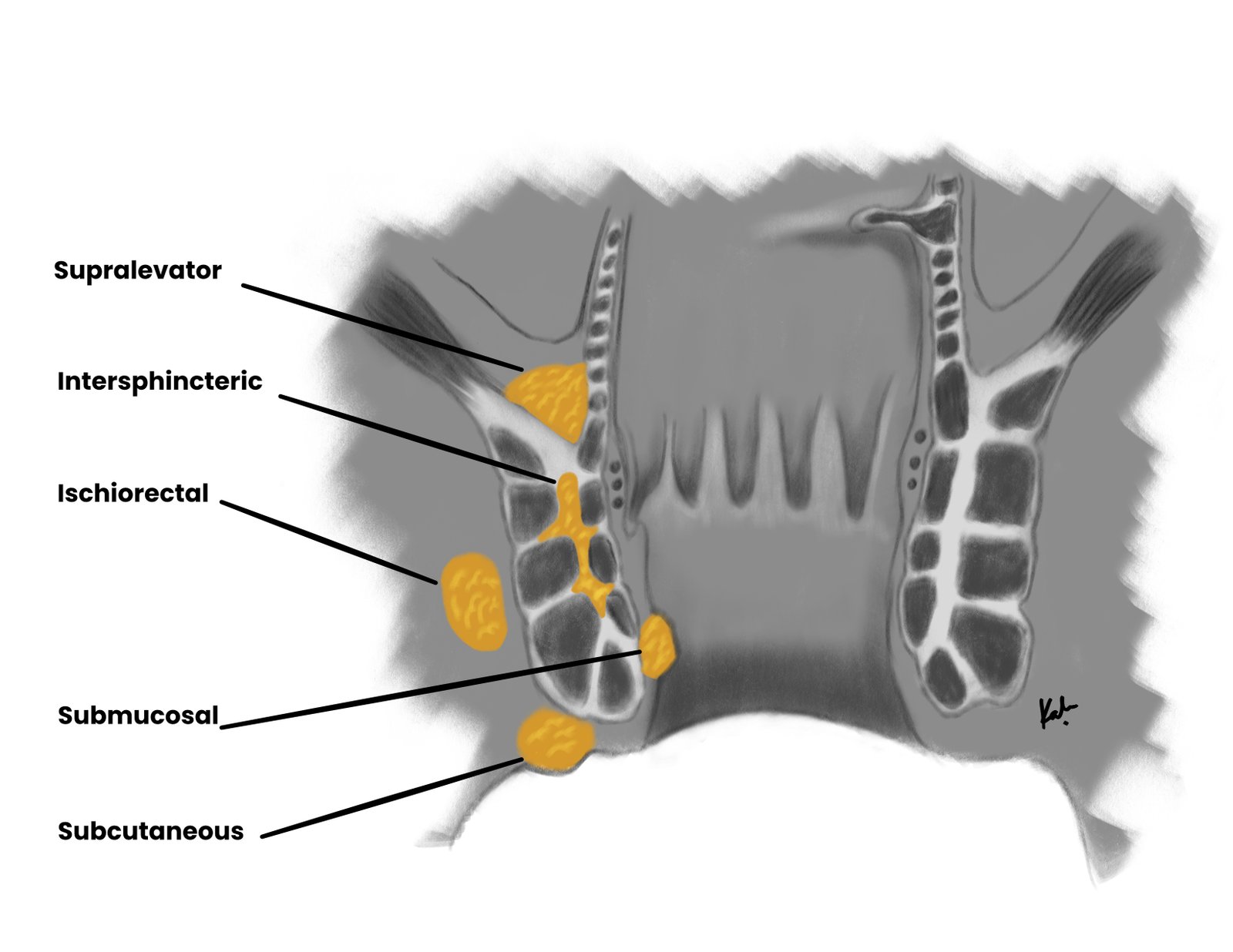 Location of anorectal abscesses