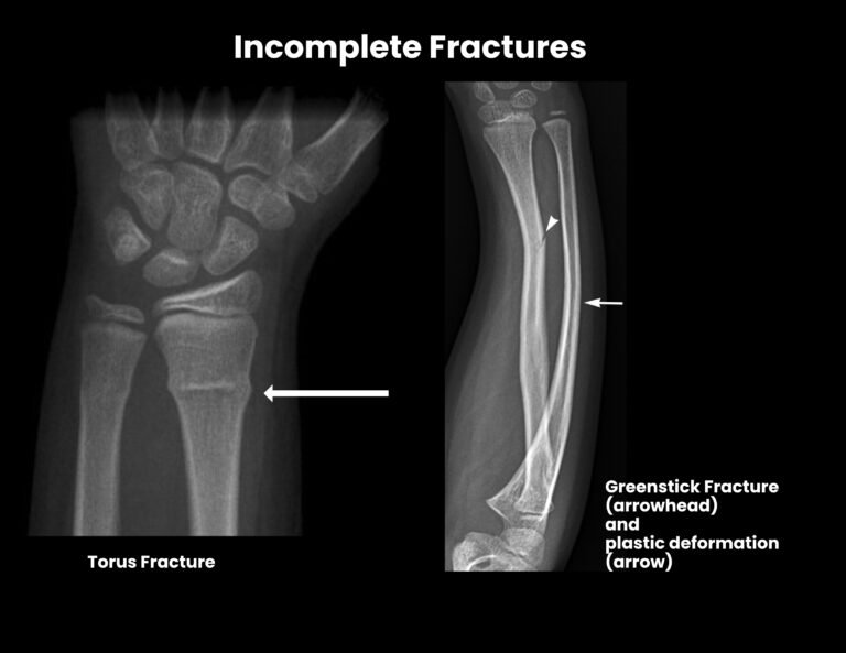 Introduction to Fractures - Hyperexcision