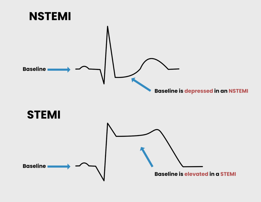 Acute Coronary Syndromes ACS Hyperexcision